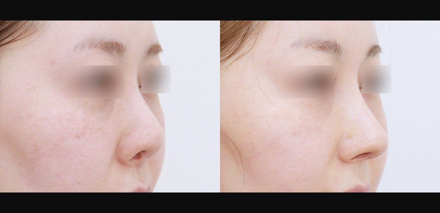 3D 코성형 재수술(콧대+코끝+비중격재건+비주처짐개선)