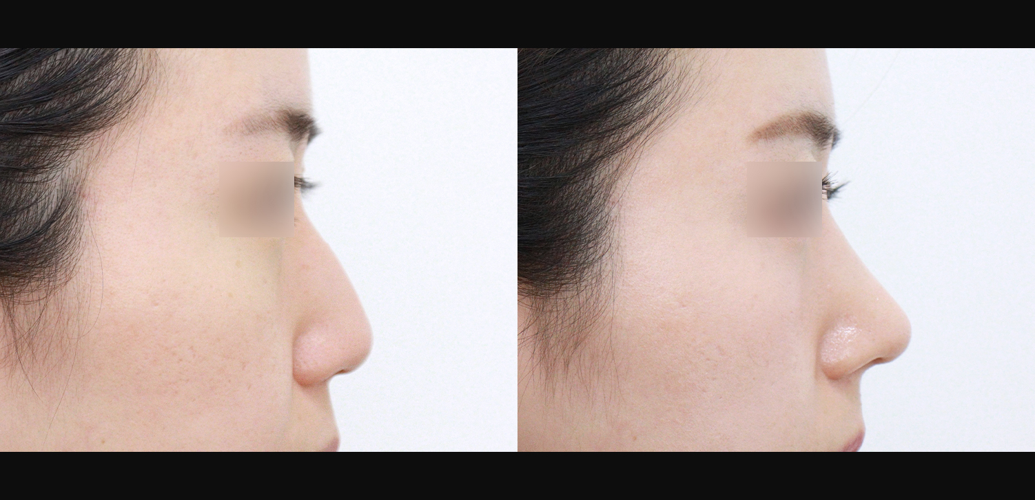 코끝+매부리+인중코+기능코