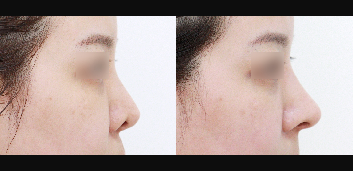 3D 코성형 재수술(콧대+코끝+찝힌코+인중코)