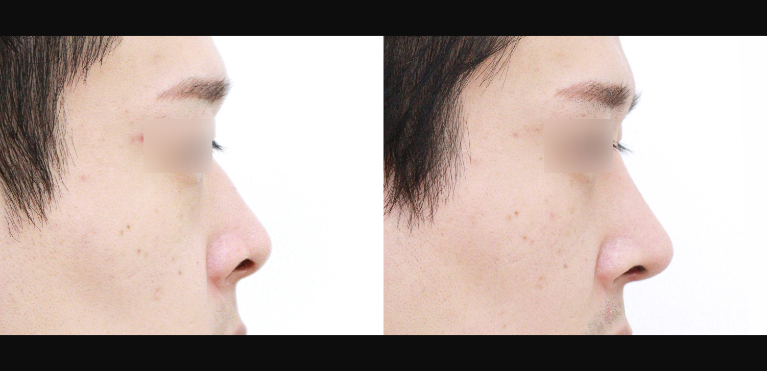 3D 코성형(콧대+코끝+휜코+기능코)