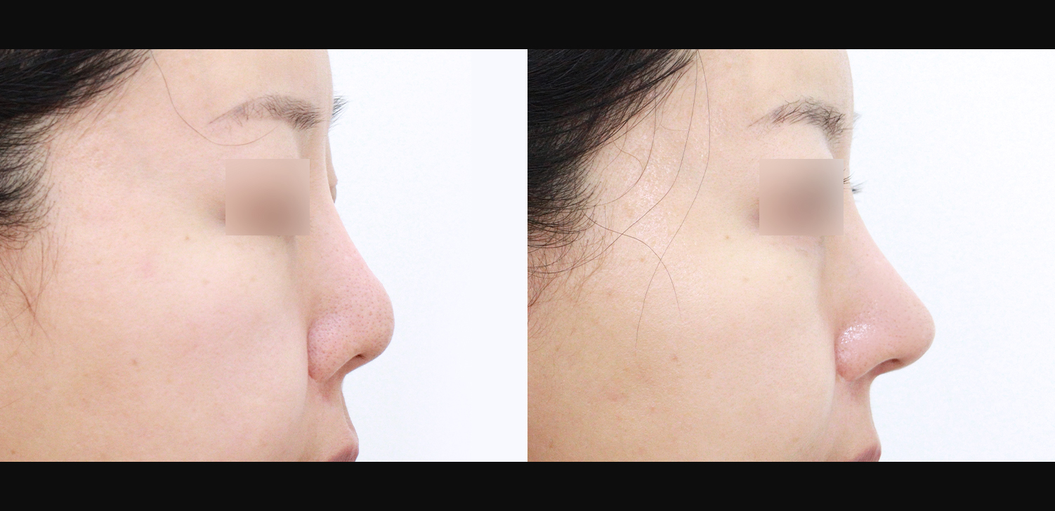 3D 코성형 재수술 (인중코+들창코+찝힌코+비중격재건+기능코)