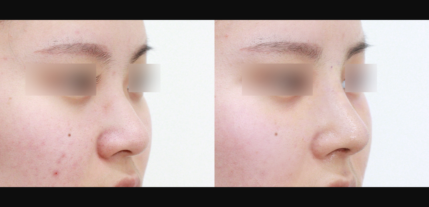 콧대+코끝+인중코+기능코