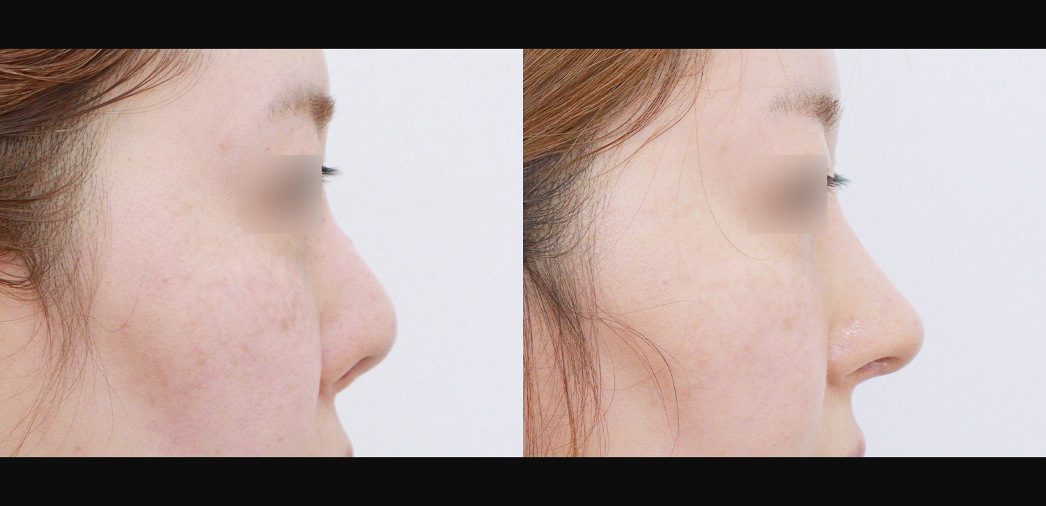 3D 코성형 재수술(콧대+코끝+비중격재건+비주처짐개선)