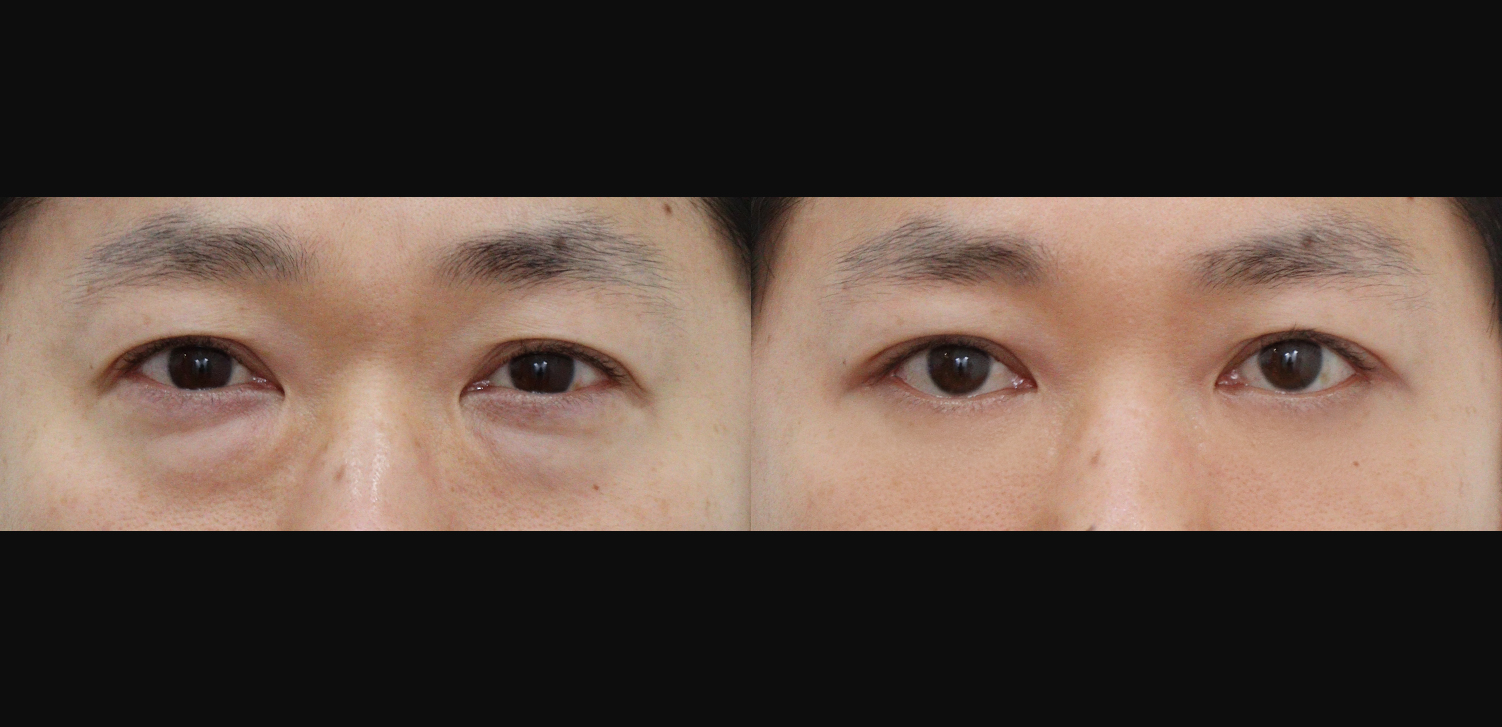 하안검+외안각고정