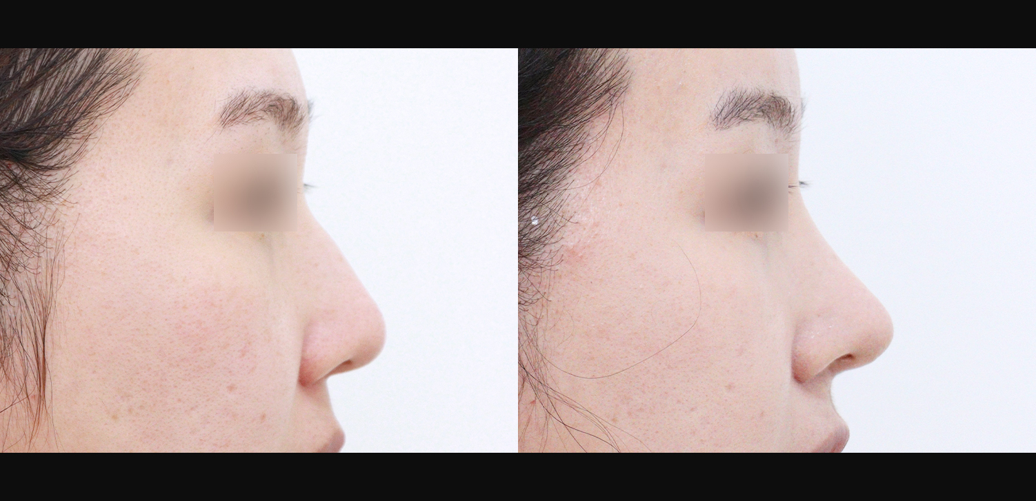 코끝+인중코+매부리+기능코