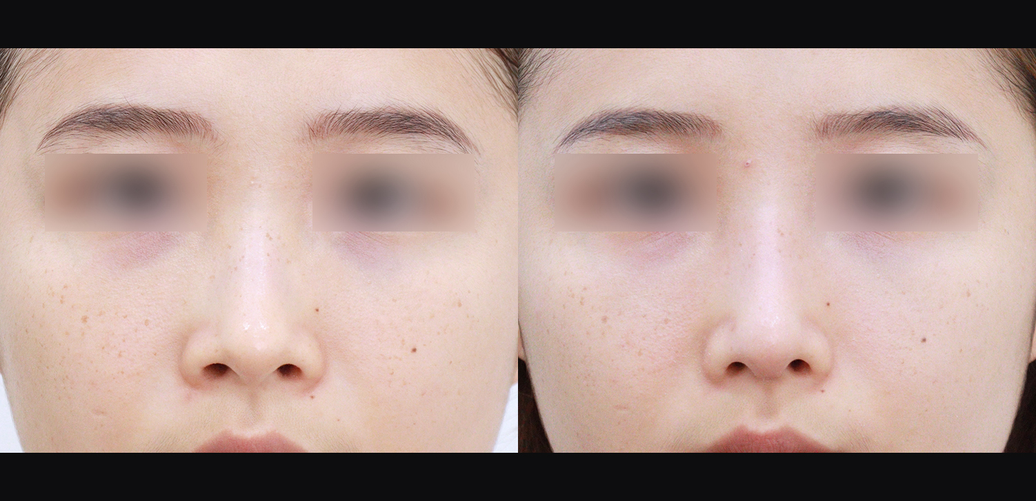 3D 코성형(콧대+코끝+들창코+인중코)