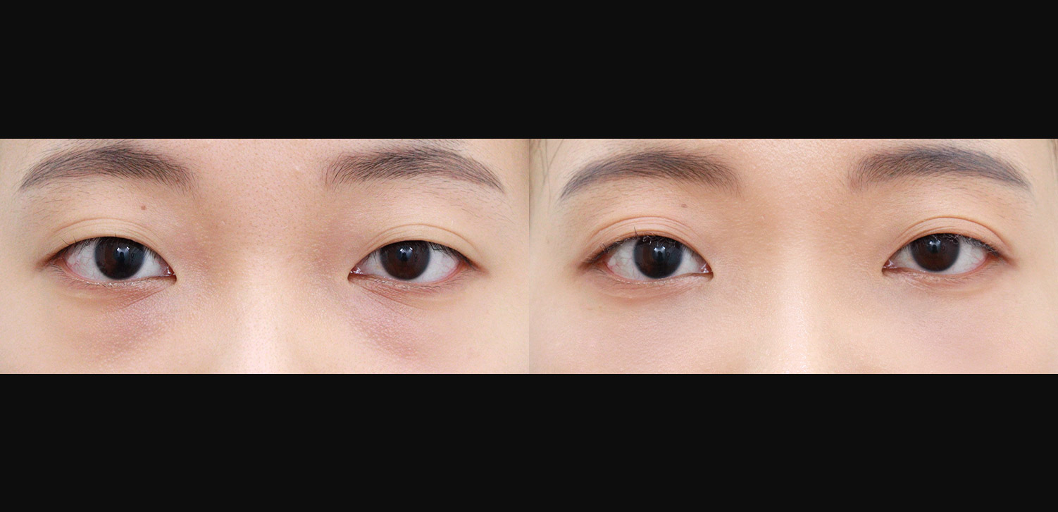 눈밑지방재배치