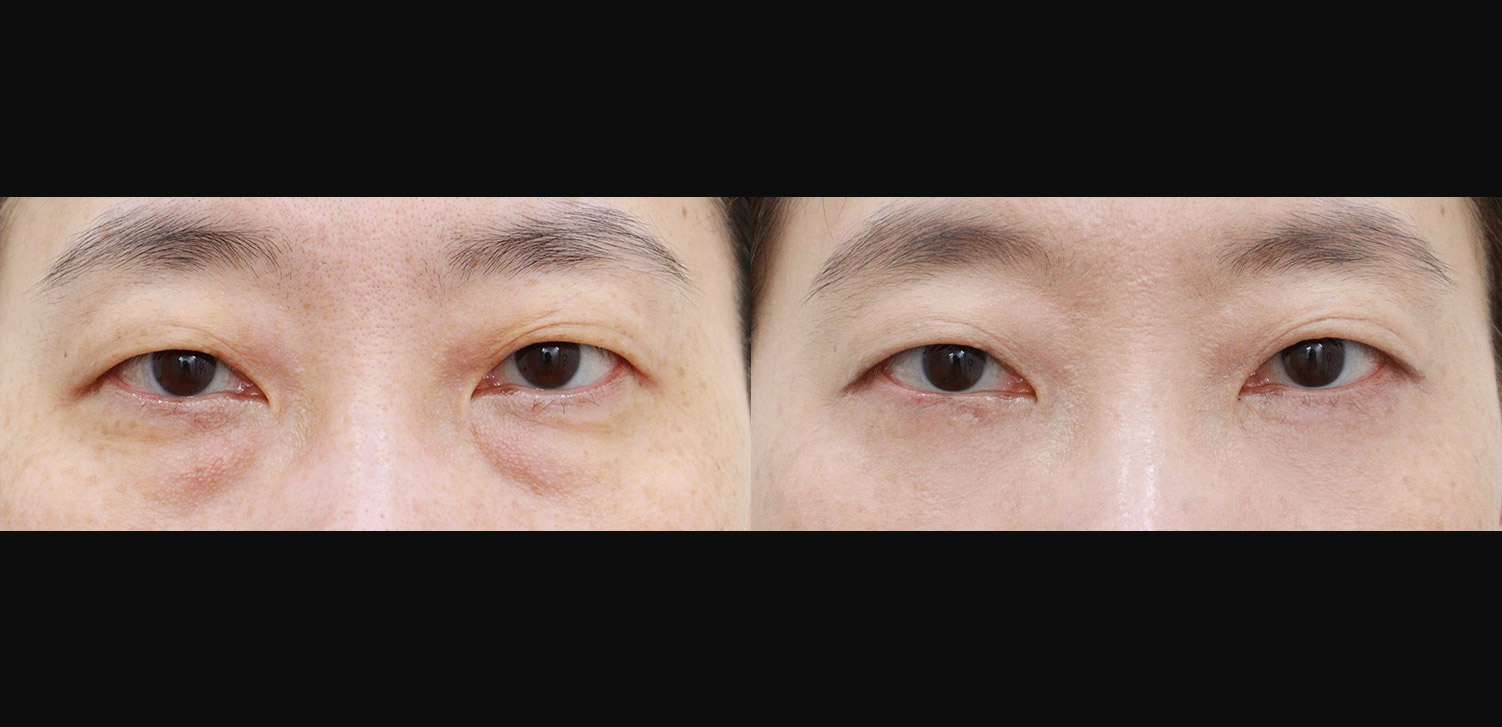 리프팅 하안검+외안각고정술