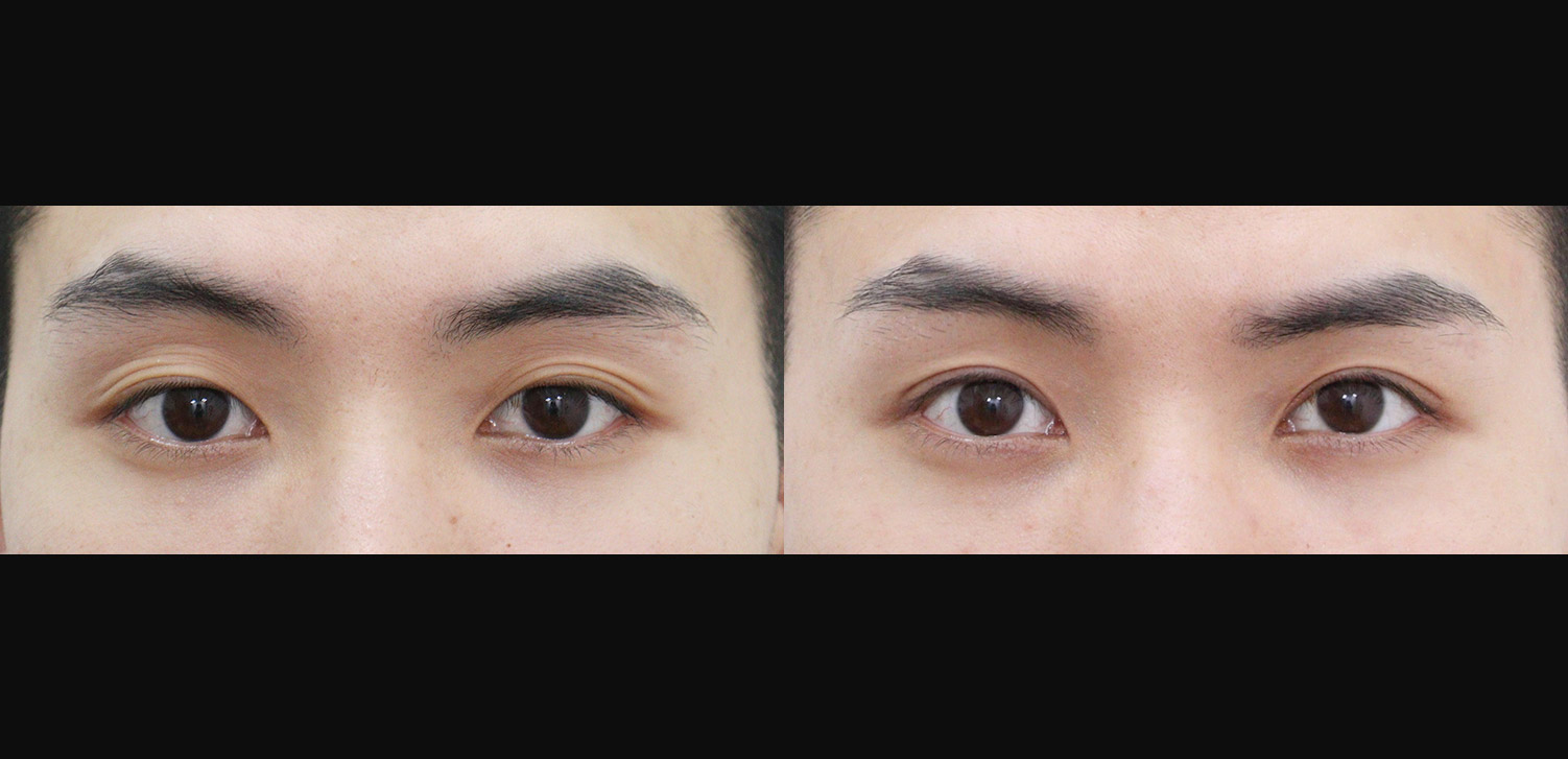절개 쌍꺼풀+눈매교정