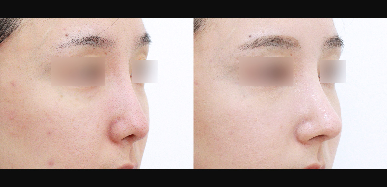 3D코성형 재수술(화살코+휜코+기능코)