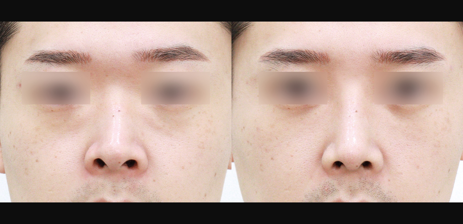 3D 코성형(콧대+코끝+휜코+기능코)