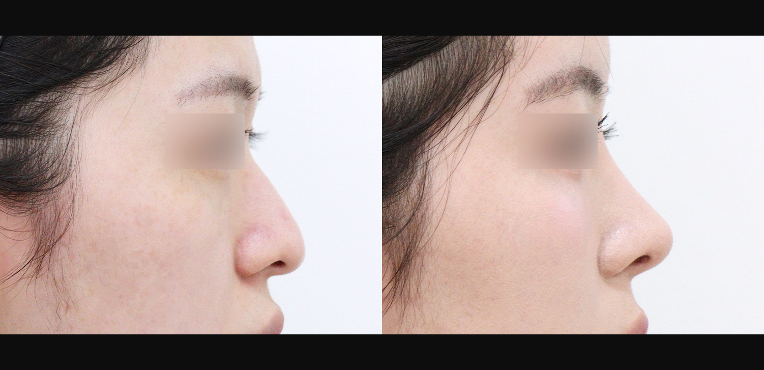 3D코성형(화살코+복코+인중코+기능코)