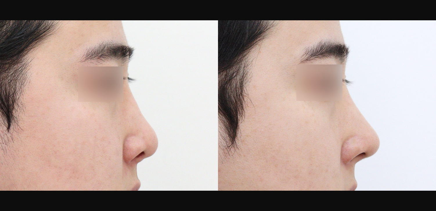 코재수술(늑연골+들창코+휜코+비중격재건+기능코)