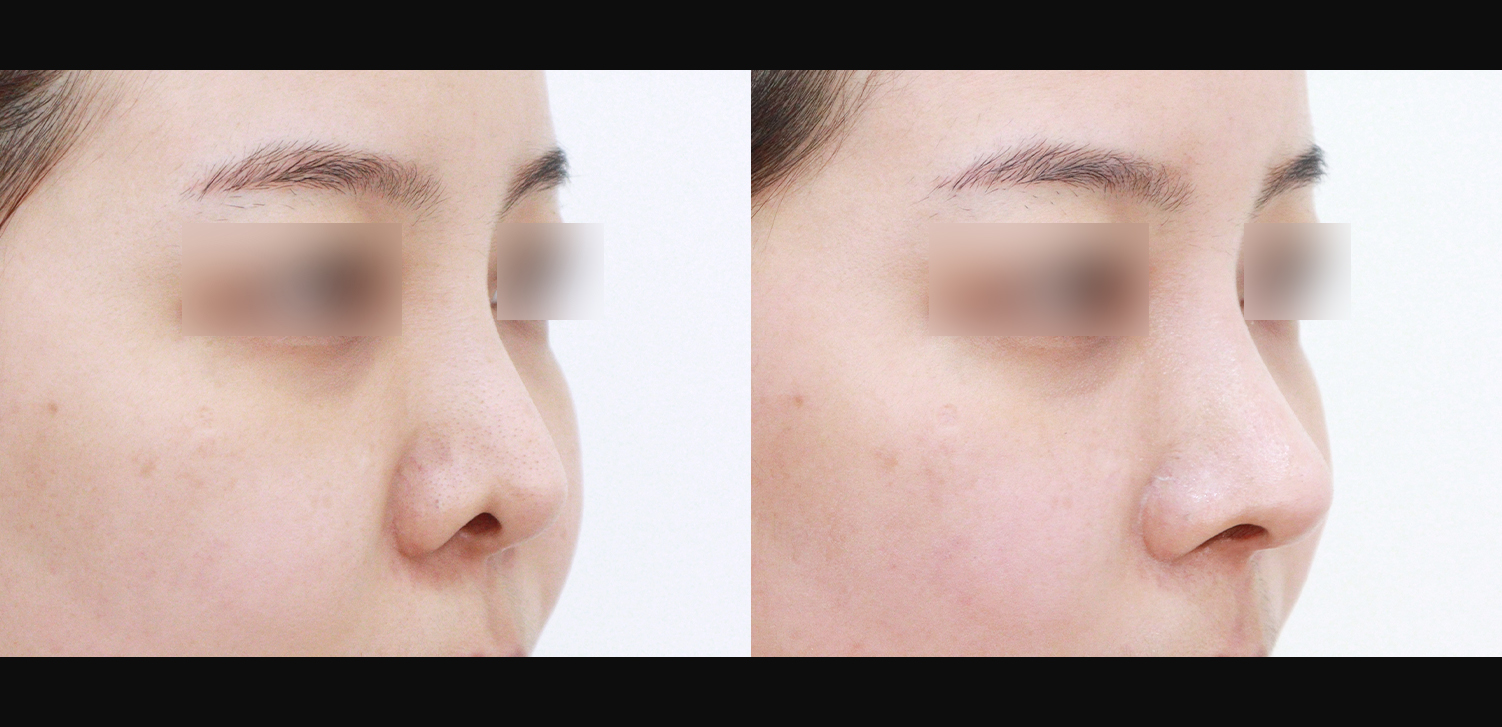 3D 코성형 재수술(콧대+코끝+찝힌코+인중코)