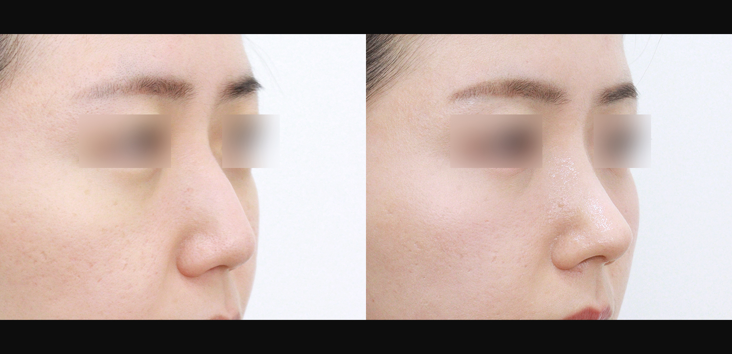 코끝+매부리+인중코+기능코