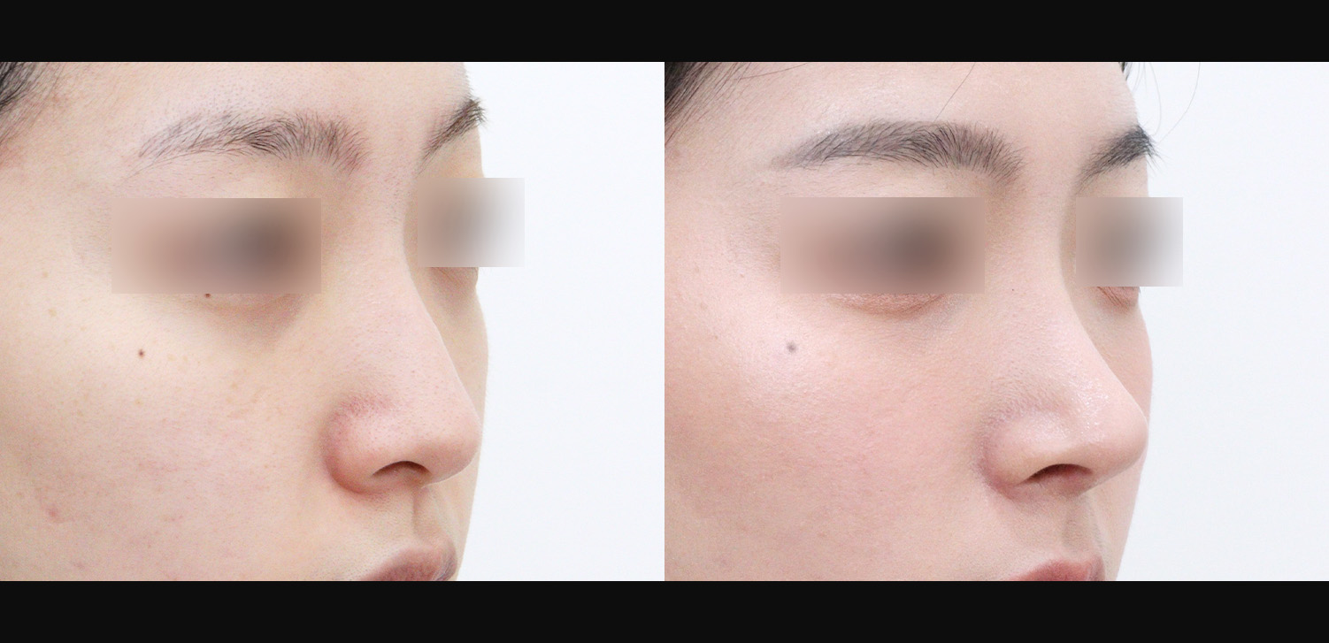 화살코+용코+휜코+인중코+콧볼축소+기능코