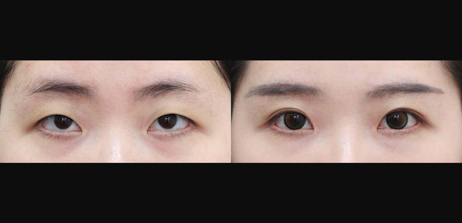 자연유착+눈매교정+트임
