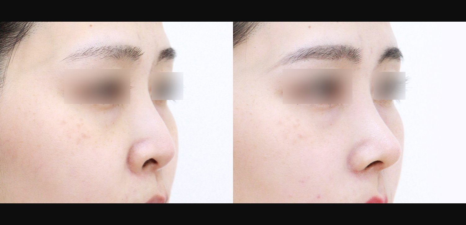 코끝+들창코+콧볼축소