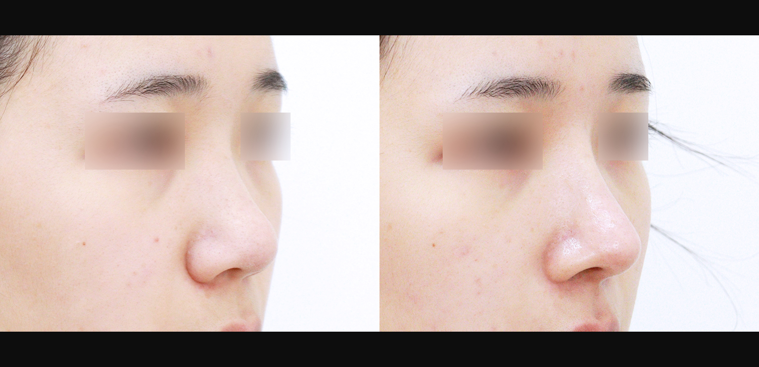 3D 코성형(복코+인중코+콧볼축소)