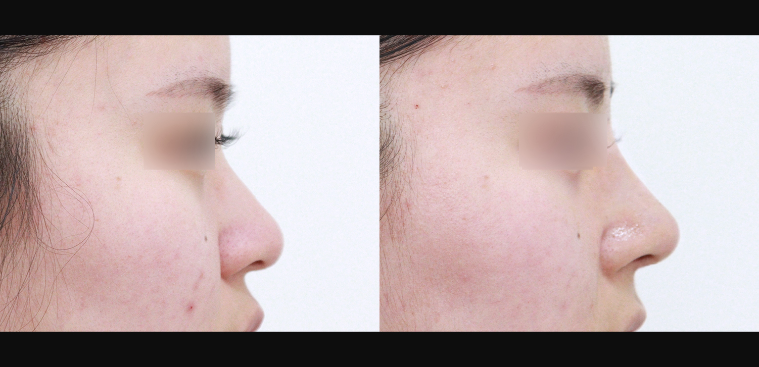 콧대+코끝+인중코+기능코