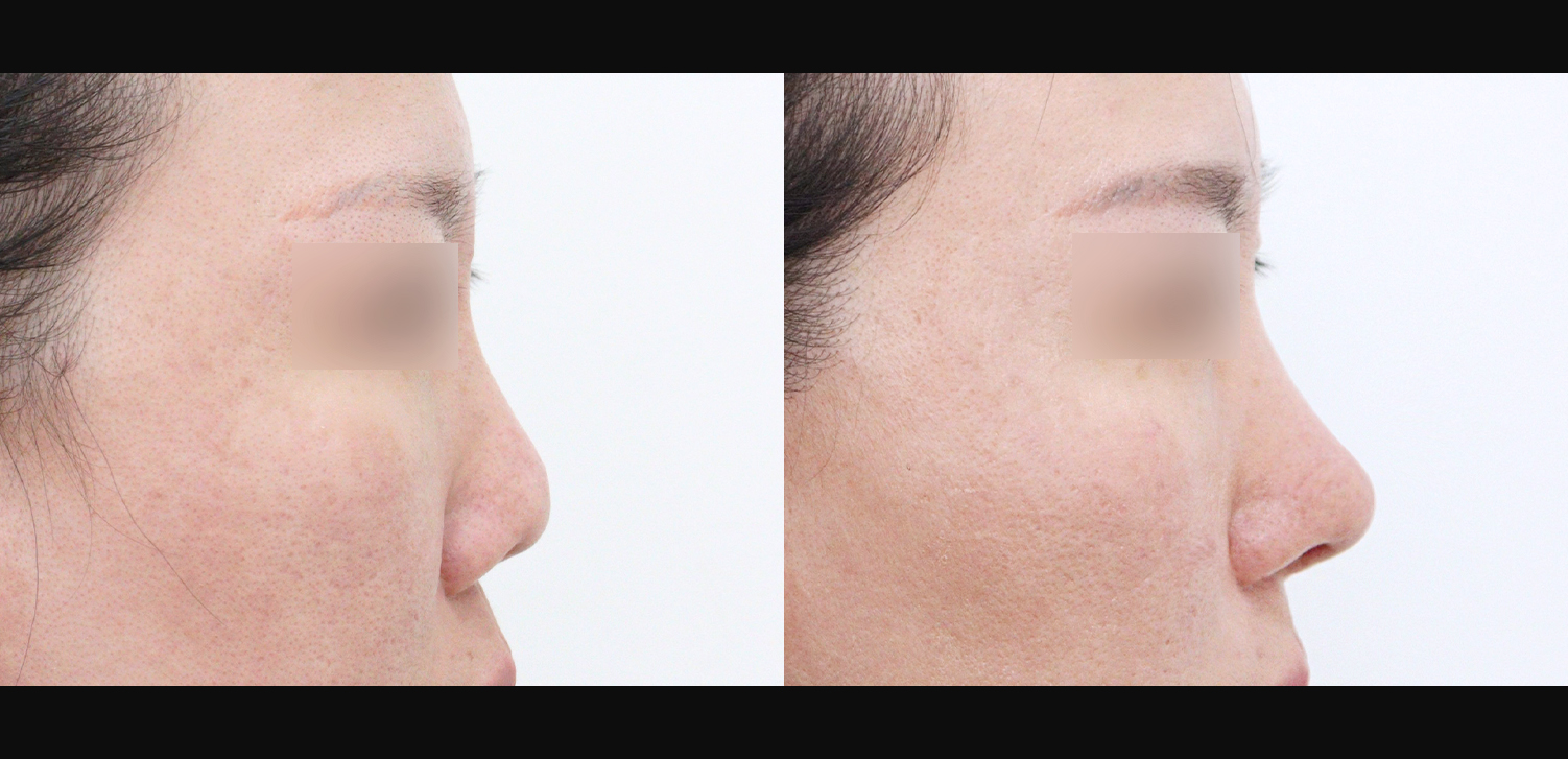 3D 코성형 재수술(자가늑+찝힌코+휜코+구축코+인중+기능코+비주빼기)