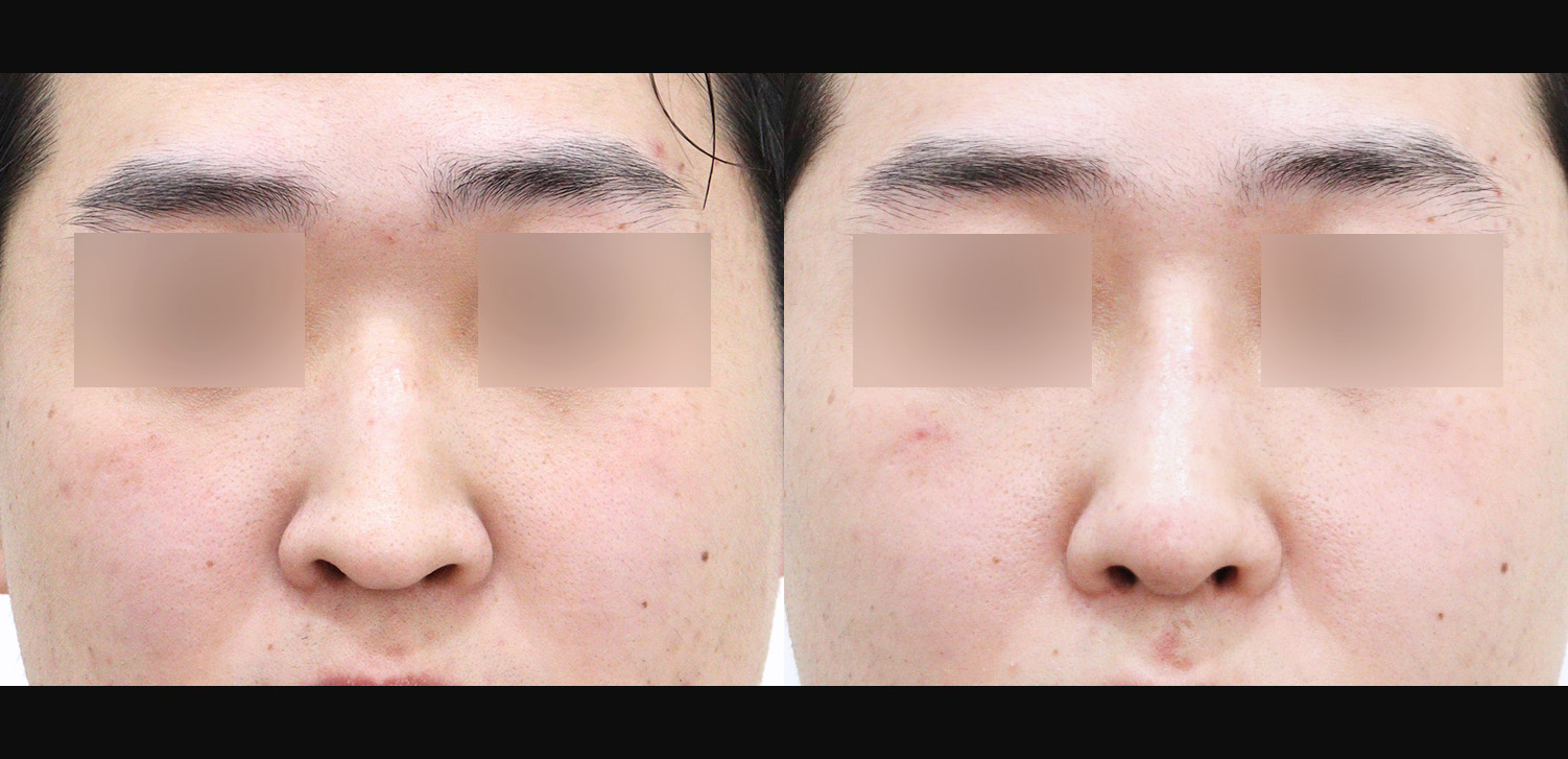 3D코성형(자가늑+콧대+코끝+매부리+화살코+용코+인중코+기능코)