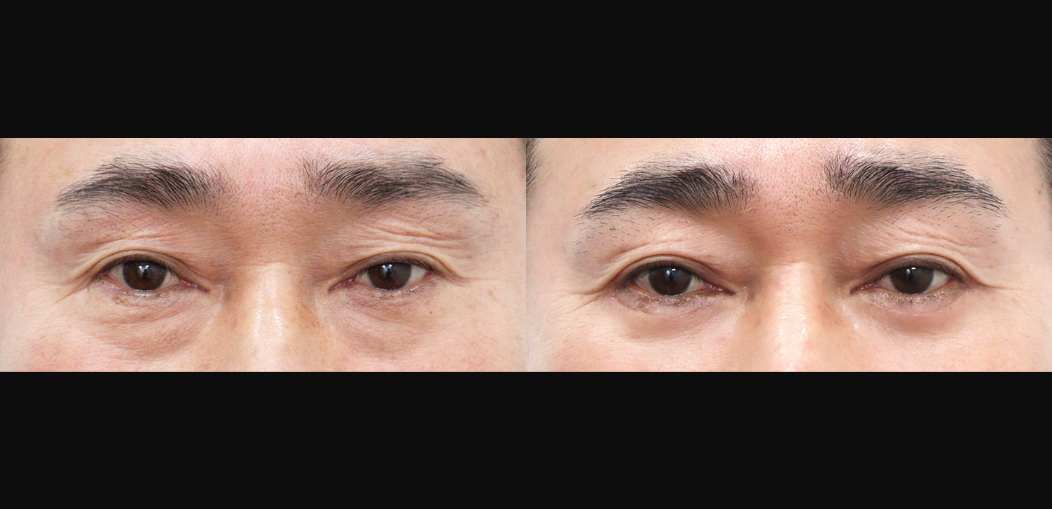 하안검+외안각고정술