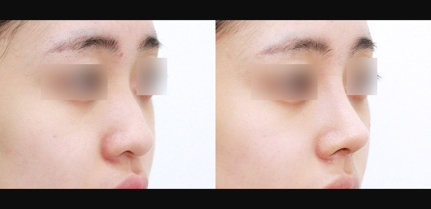 3D 코성형(복코+매부리코+인중코)