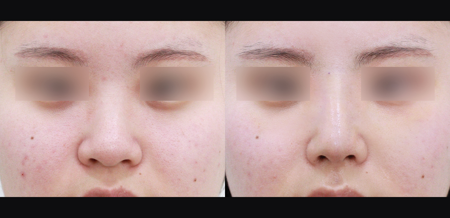 콧대+코끝+인중코+기능코