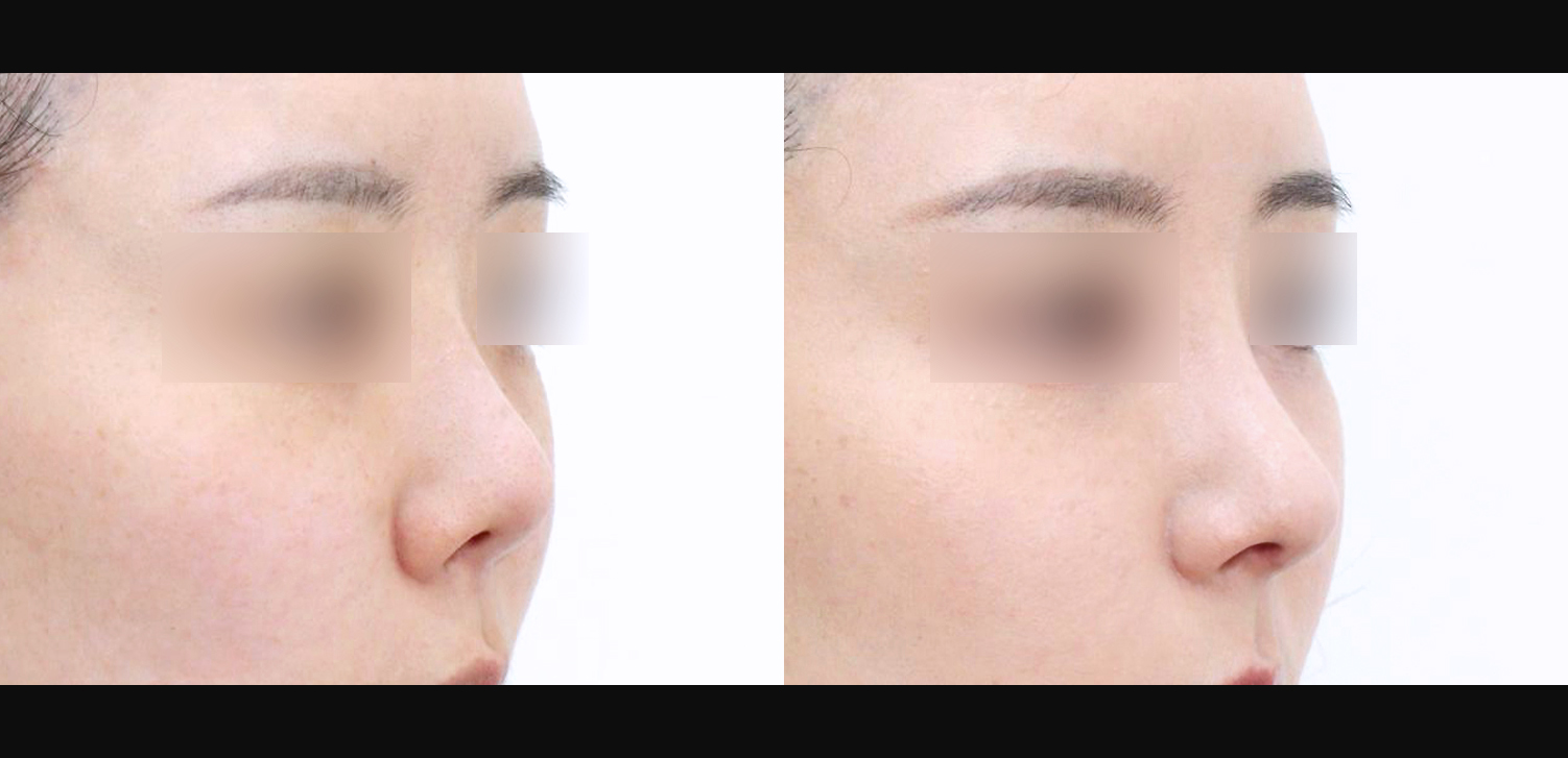 3D 코성형 재수술(자가늑+들창코+복코+인중코)