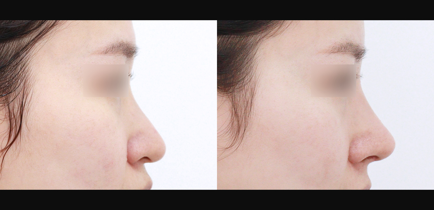 3D 코성형(콧대+코끝+화살코+콧볼축소+인중코+기능코)