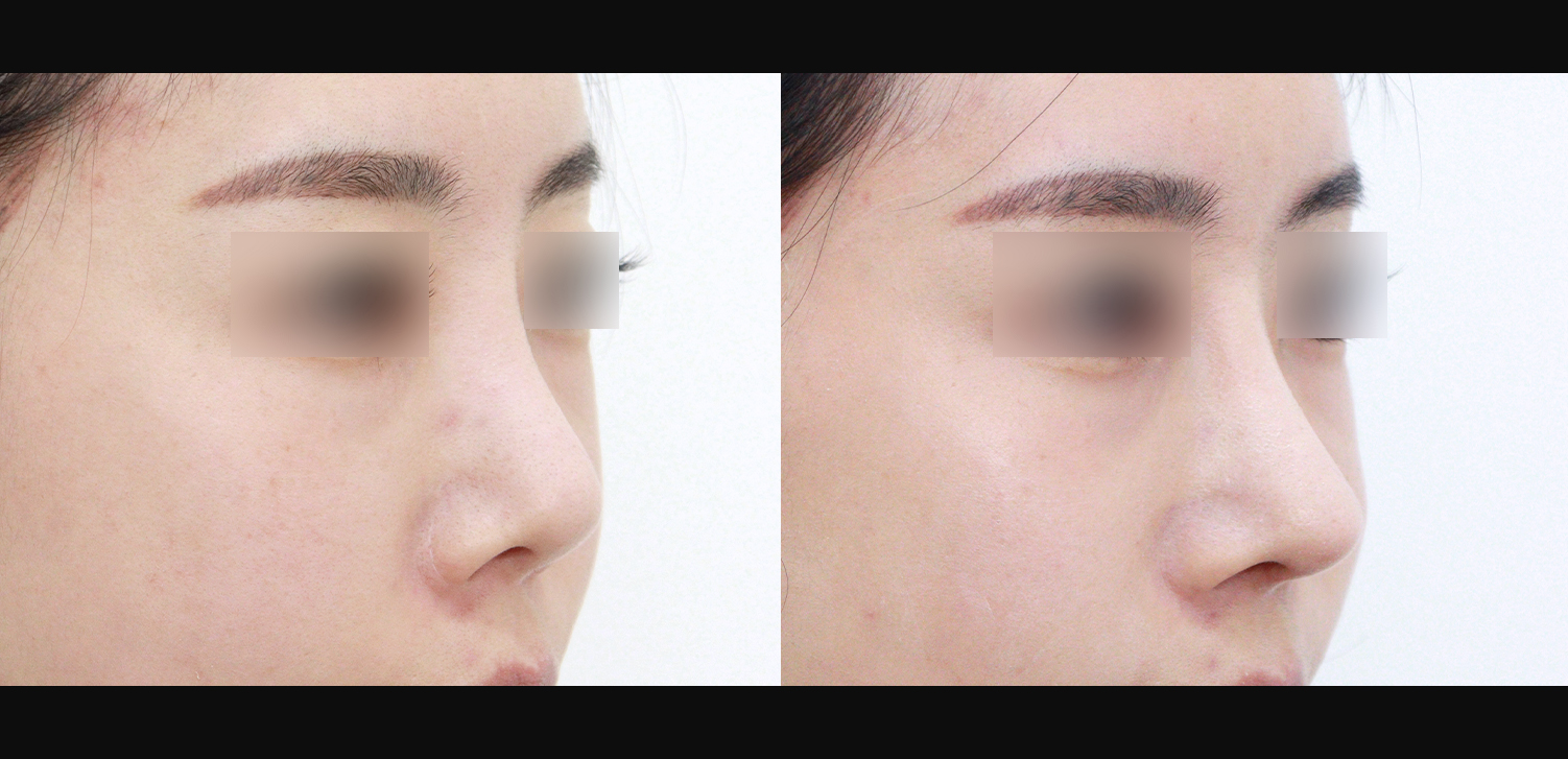 3D 코성형 재수술(콧대+코끝+들창코+인중코)