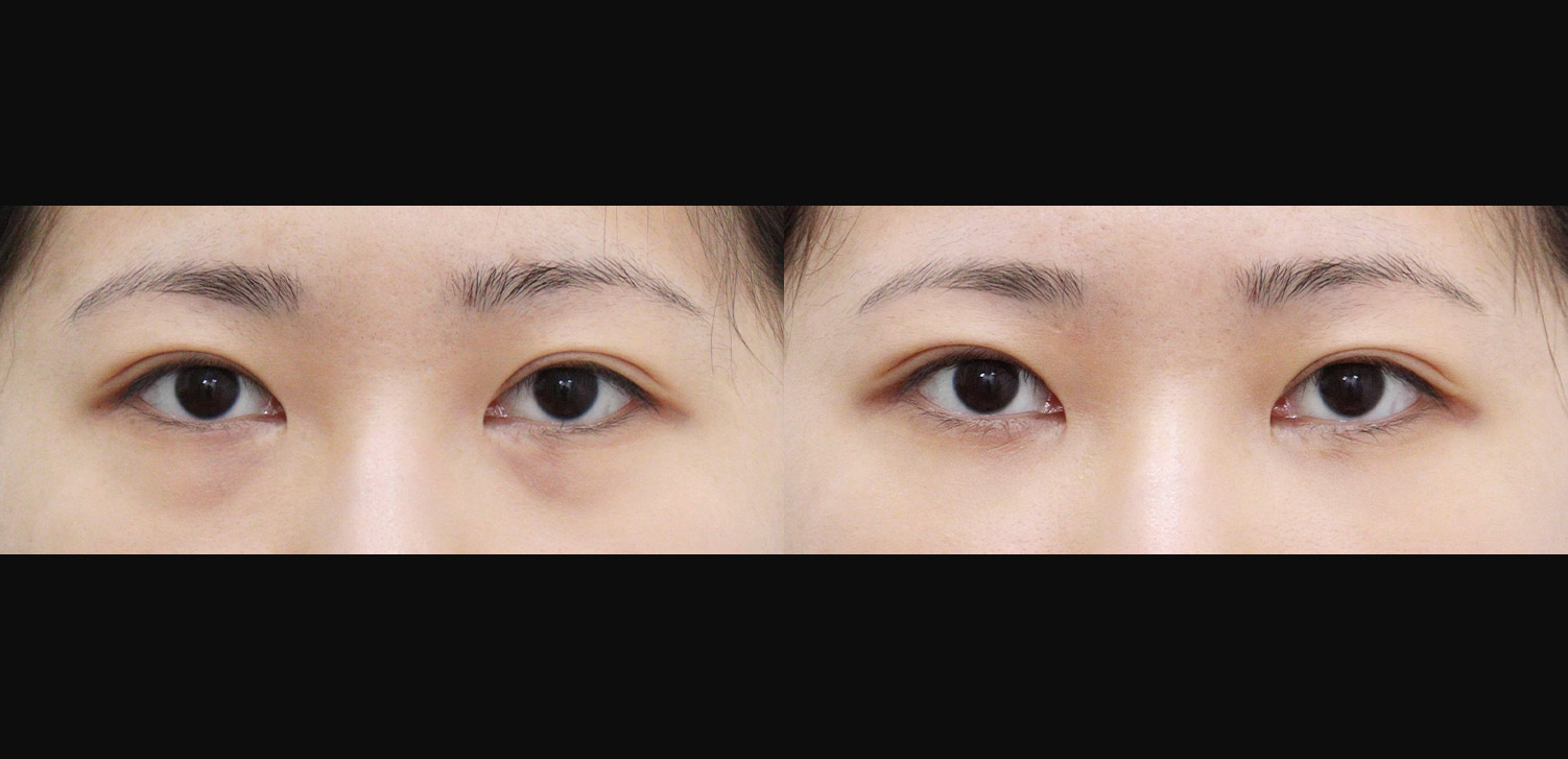 눈밑지방재배치+지방이식(앞광대)