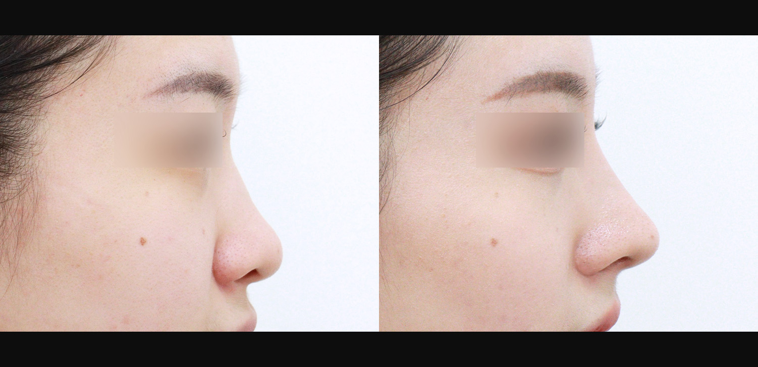 3D코성형(복코+비추처짐개선+인중코+콧볼축소)