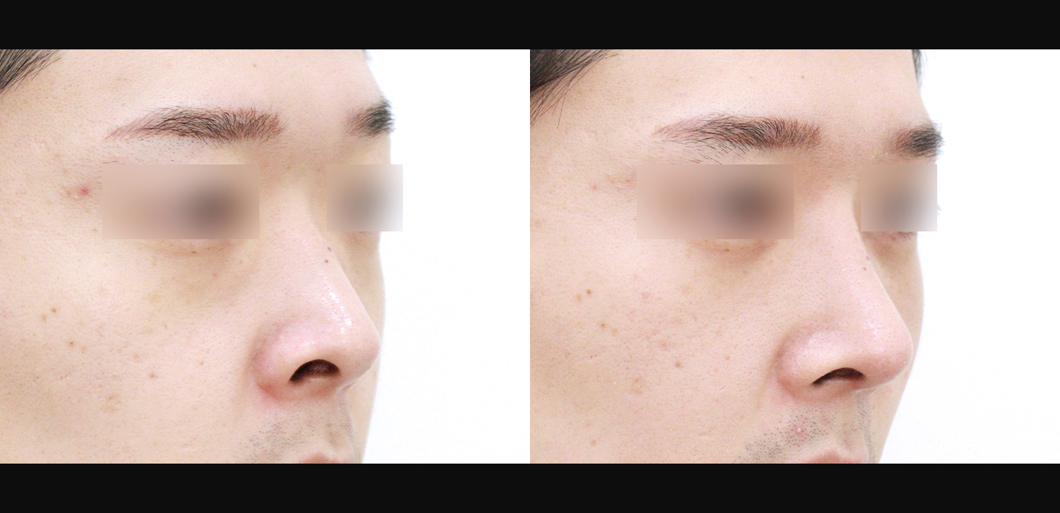 3D 코성형(콧대+코끝+휜코+기능코)