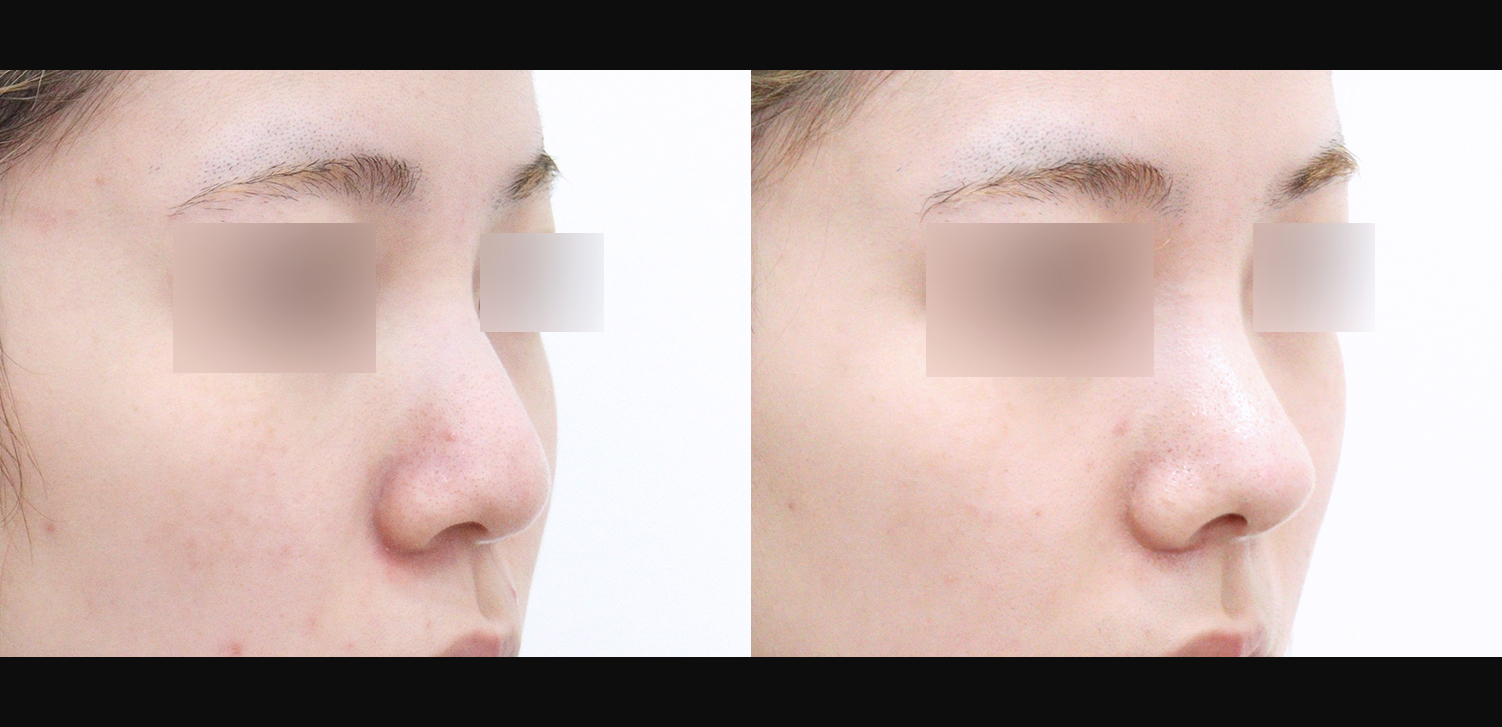 코끝+복코+인중+매부리+기능코