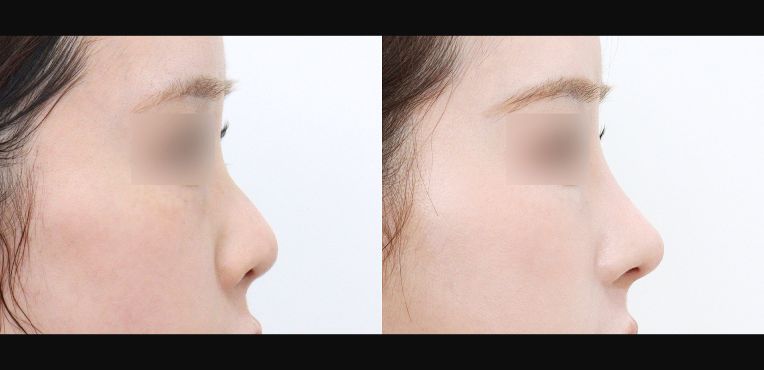 3D 코성형(자가늑+들창코+복코+인중코)