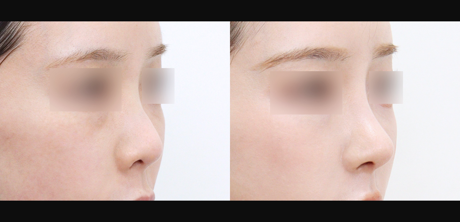 3D 코성형(자가늑+들창코+복코+인중코)