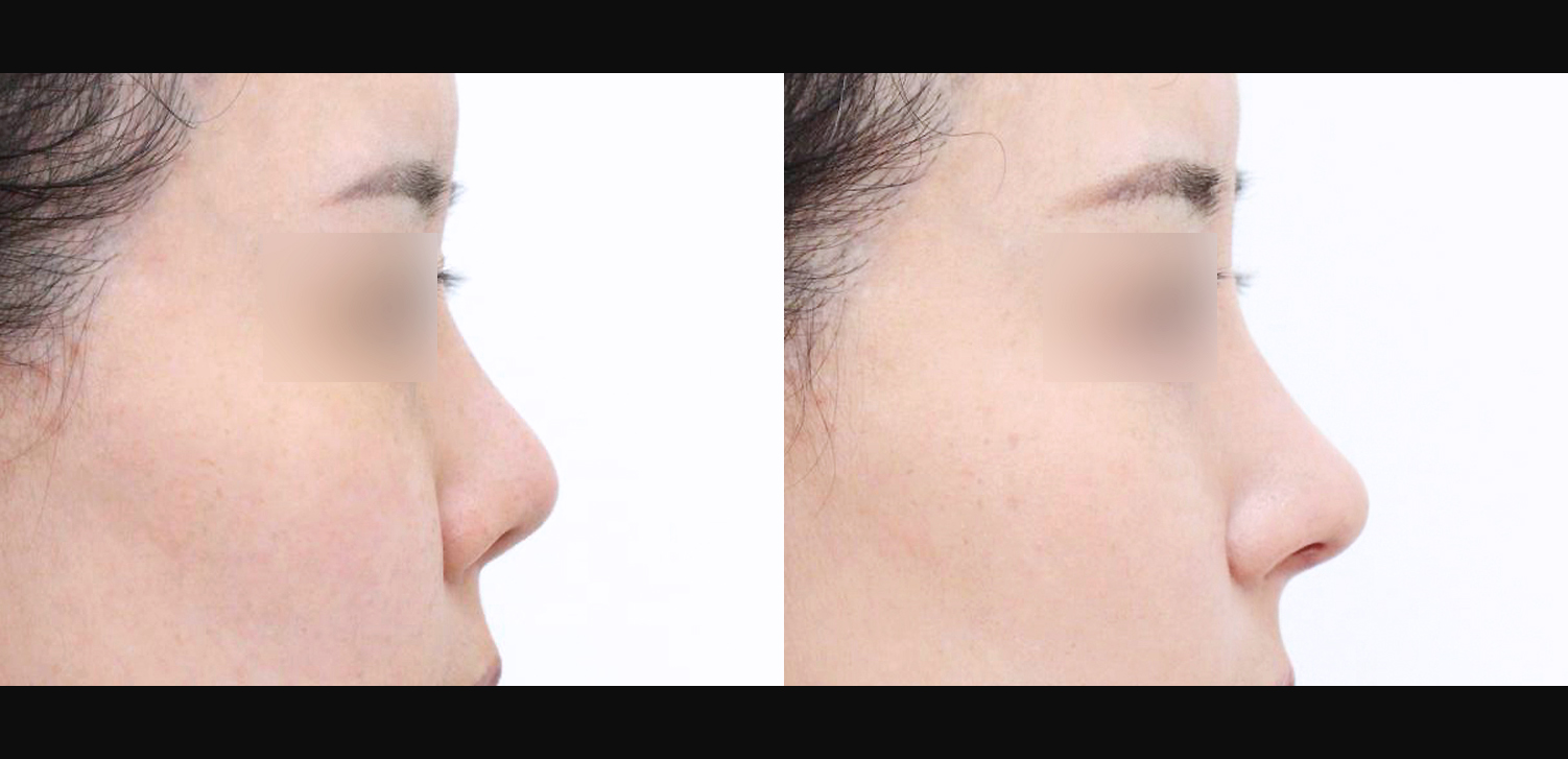 3D 코성형 재수술(자가늑+들창코+복코+인중코)