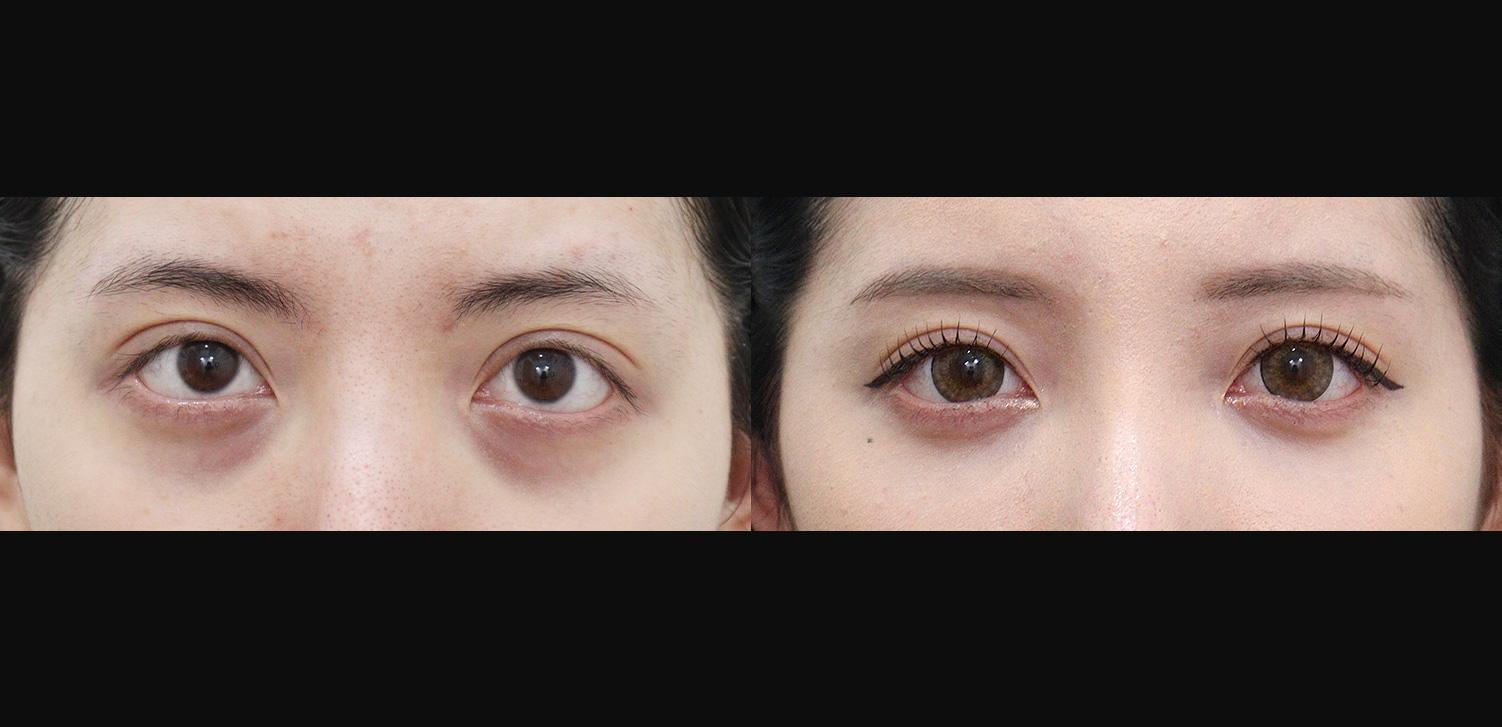 눈밑지방재배치+지방이식(앞광대)