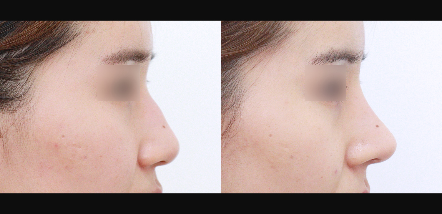 콧대+코끝+매부리+인중코+기능코