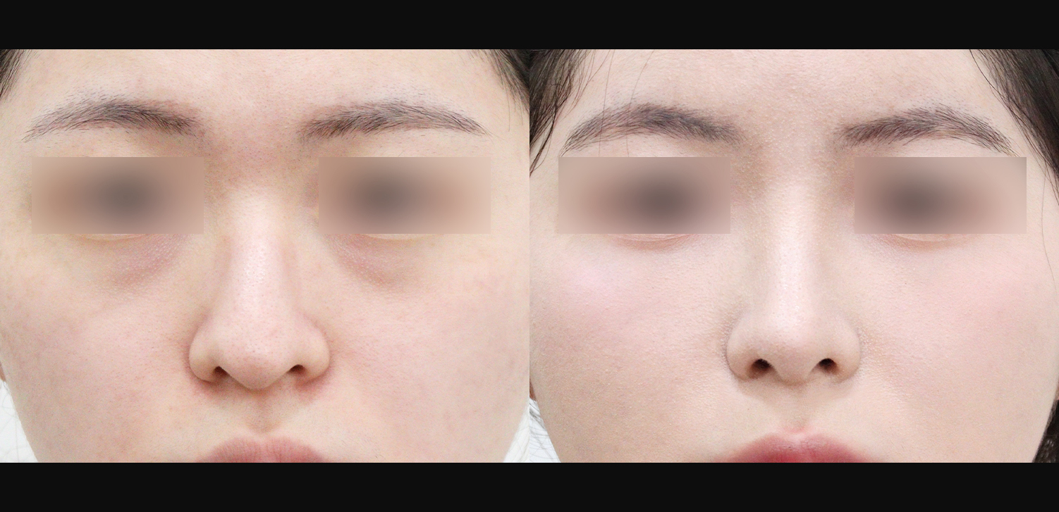 3D코성형(화살코+복코+인중코+기능코)