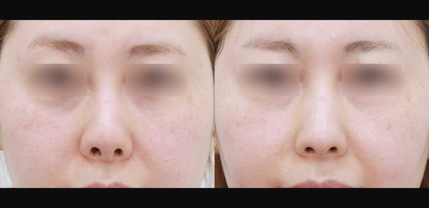 3D 코성형 재수술(콧대+코끝+비중격재건+비주처짐개선)