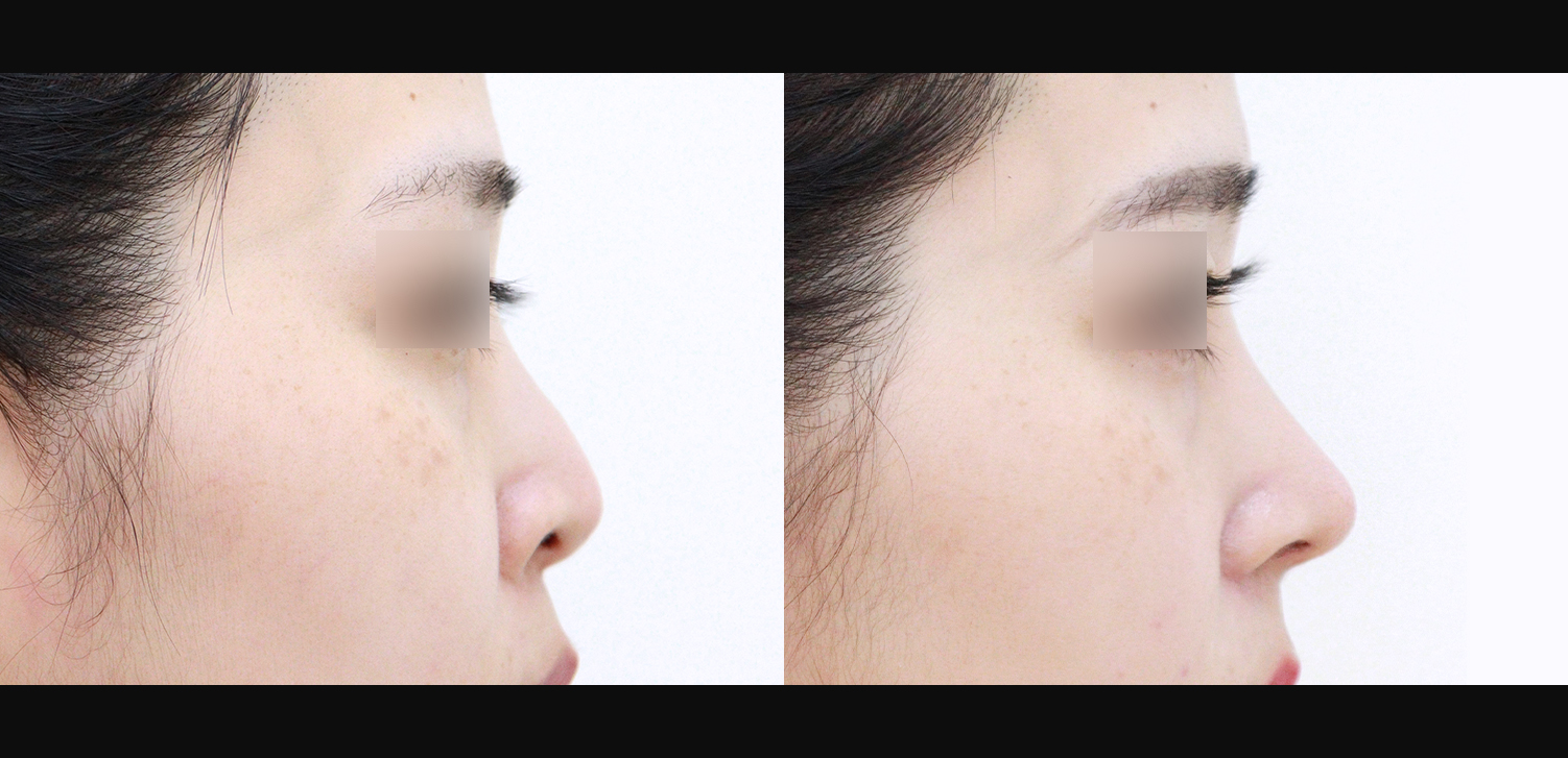 코끝+들창코+콧볼축소