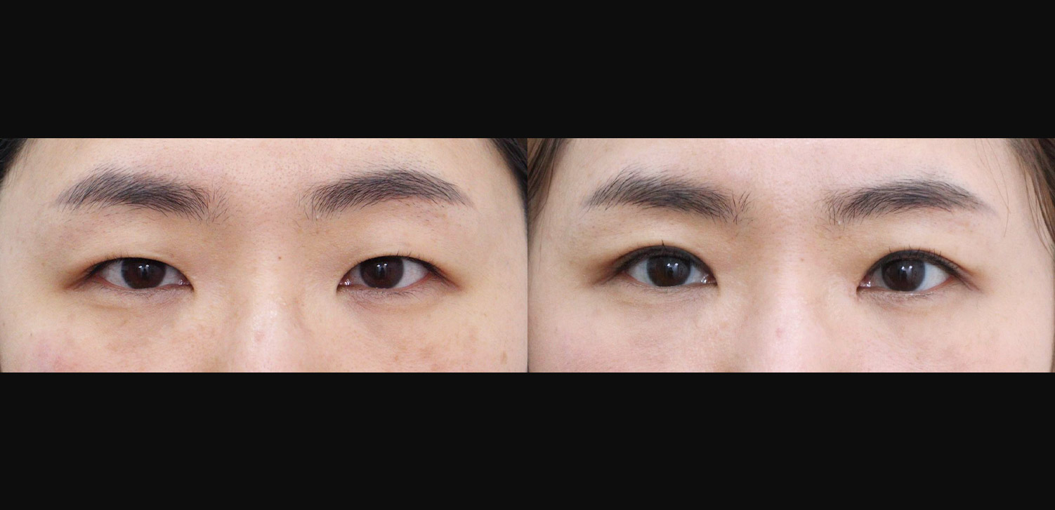 절개 쌍꺼풀+눈매교정