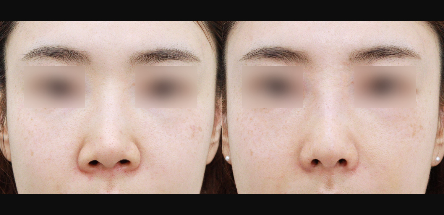 3D 코성형 재수술(콧대+코끝+콧볼축소+인중코)