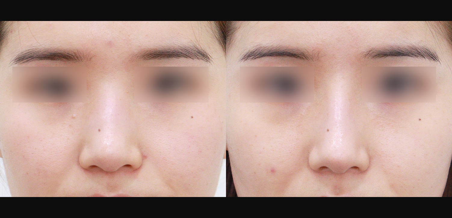 콧대+코끝+매부리+인중코+기능코