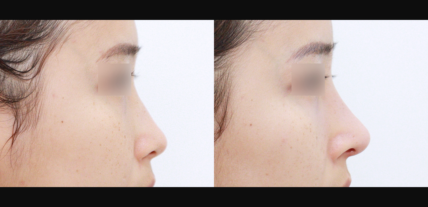 3D 코성형(콧대+코끝+들창코+인중코)