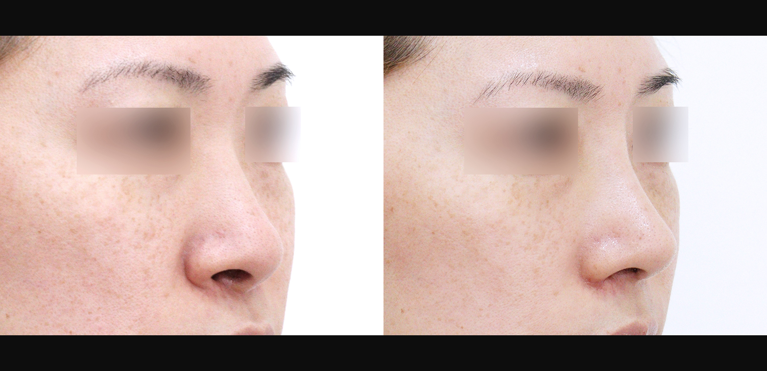 3D코성형(자가늑+용코+인중코+콧볼축소+기능코)