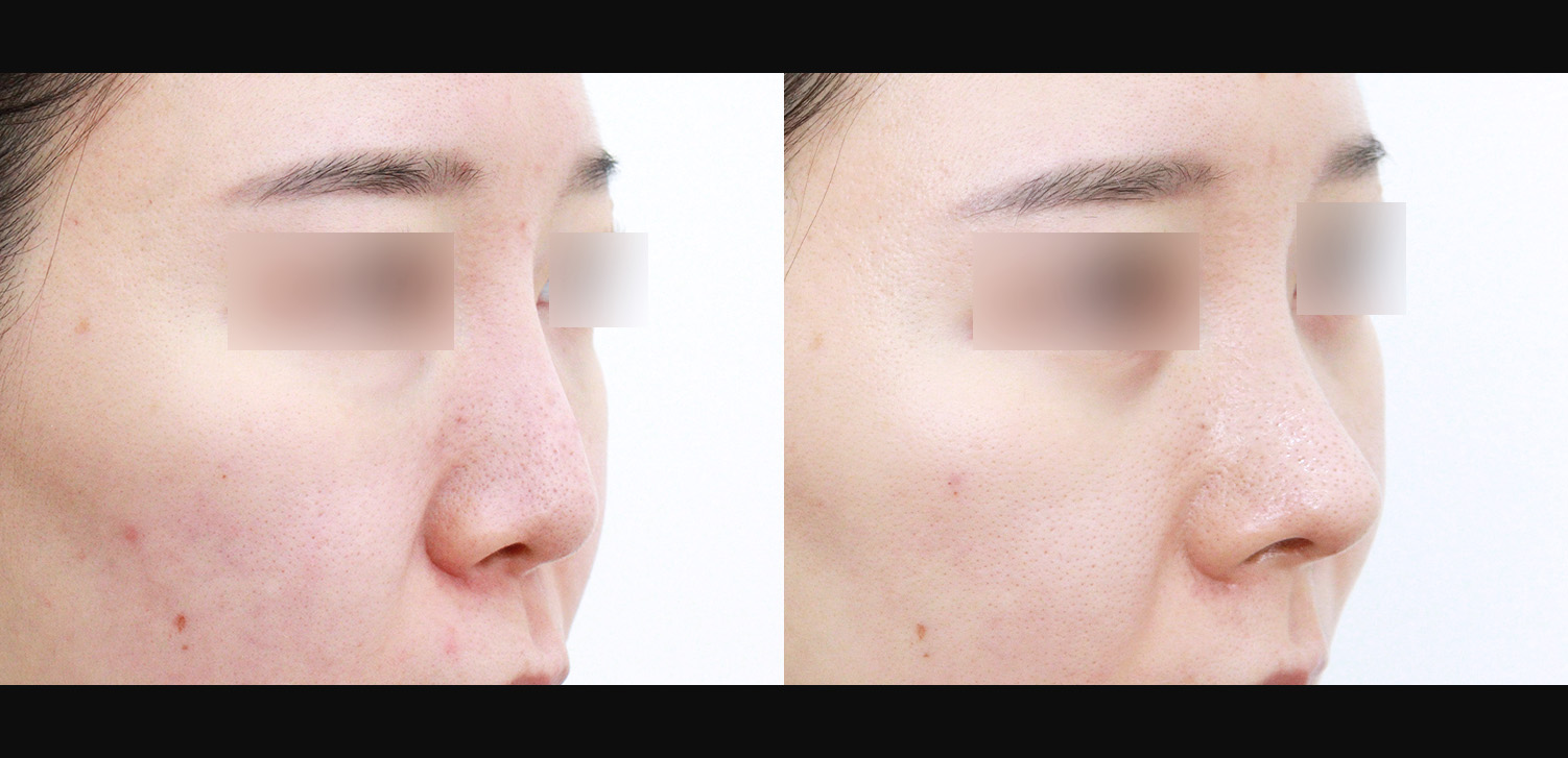 3D코성형 재수술(인중코+기능코)